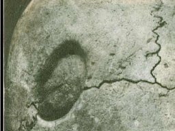 trepanacia